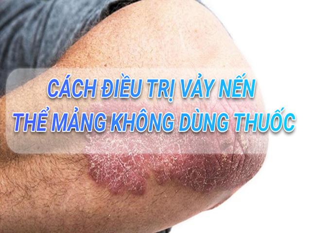 Mách bạn cách loại bỏ vảy nến thể mảng đơn giản, hiệu quả