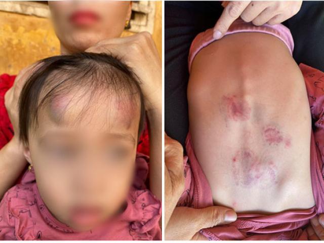 Bé gái 2 tuổi ở Bắc Giang bị bạn cắn, đánh trong lớp học: Phòng GD&ĐT nói gì?